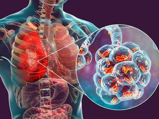 Respiratory Tract Infections