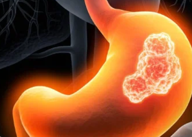 Gastrointestinal Stromal Tumors (GIST)