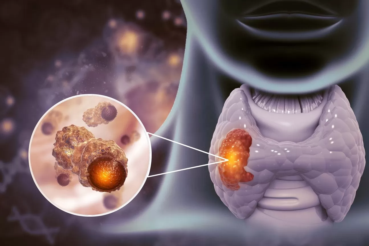 Thyroid Cancer